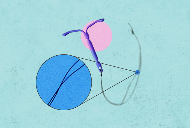 a purple IUD device on a blue background a circle is zoomed in on the string