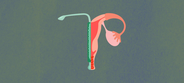 The-female-reproductive-system-is-shown-with-the-left-half-represented-by-an-IUD